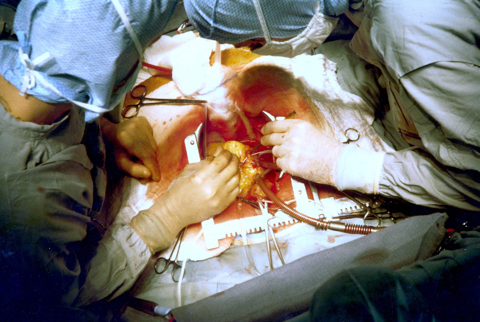 Heart Surgery